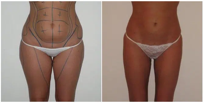 Comment se passe la liposuccion ?