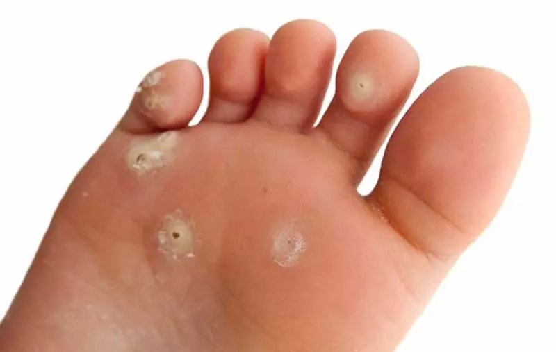 Comment soigner les cors aux pieds naturellement ?