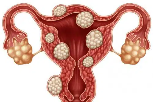 Comment assécher un fibrome naturellement ?