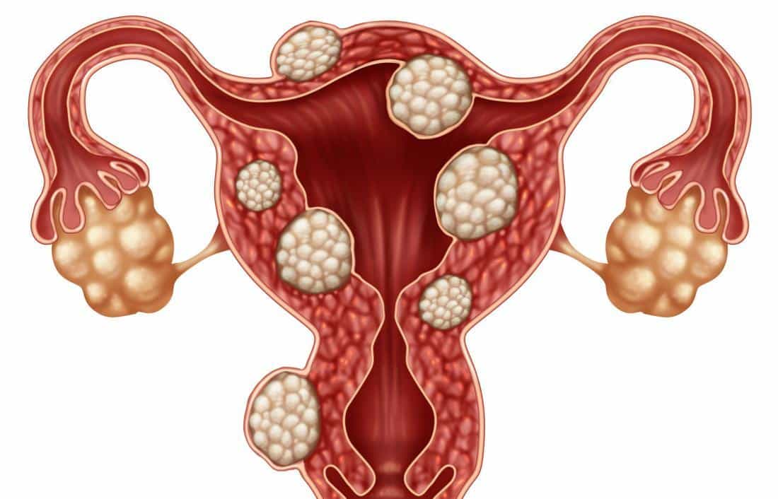 Comment assécher un fibrome naturellement ?