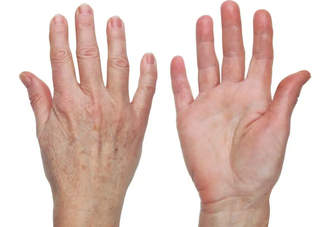 Comment enlever les taches de vieillesse sur les mains naturellement ?